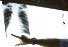 SANITA’ / RADIOLOGIE “ASL FA PAGARE CONTRIBUTO DIGITALIZZAZIONE, MA AL POSTO DEL CD CONSEGNA LA VECCHIA LASTRA”