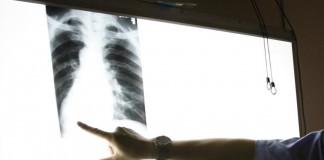 SANITA’ / RADIOLOGIE “ASL FA PAGARE CONTRIBUTO DIGITALIZZAZIONE, MA AL POSTO DEL CD CONSEGNA LA VECCHIA LASTRA”
