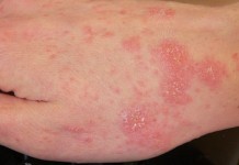 SCABBIA IN OSPEDALE SAN DONATO DI AREZZO: DISSERO “3 CASI” ERANO SETTE VOLTE TANTO. MA EPIDEMIA SOTTO CONTROLLO DA META’ MAGGIO