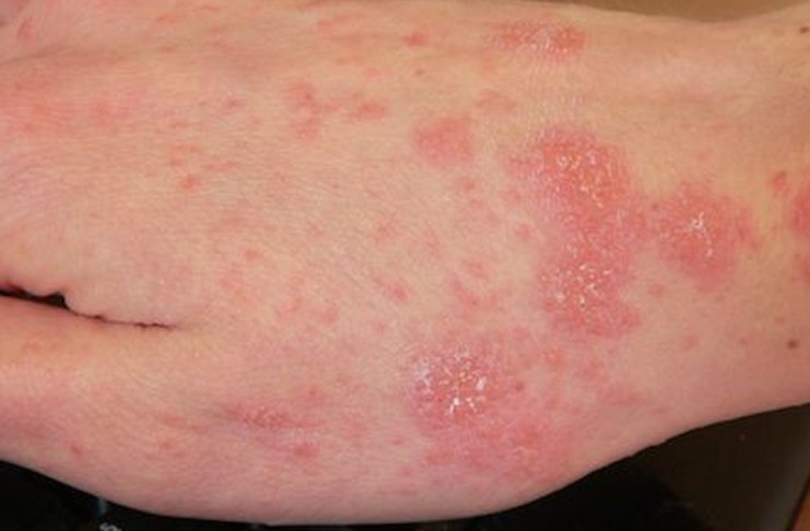 SCABBIA IN OSPEDALE SAN DONATO DI AREZZO: DISSERO “3 CASI” ERANO SETTE VOLTE TANTO. MA EPIDEMIA SOTTO CONTROLLO DA META’ MAGGIO