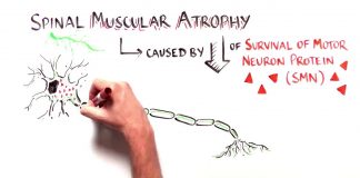 SPINRAZA, SPERANZA IN RITARDO
